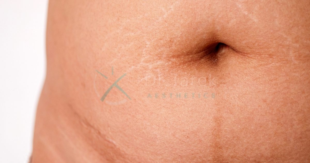 Are Liposuction Scars Noticeable