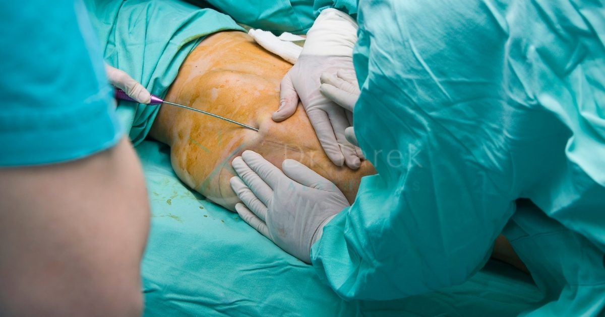 Awake Liposuction And Fat Transfer