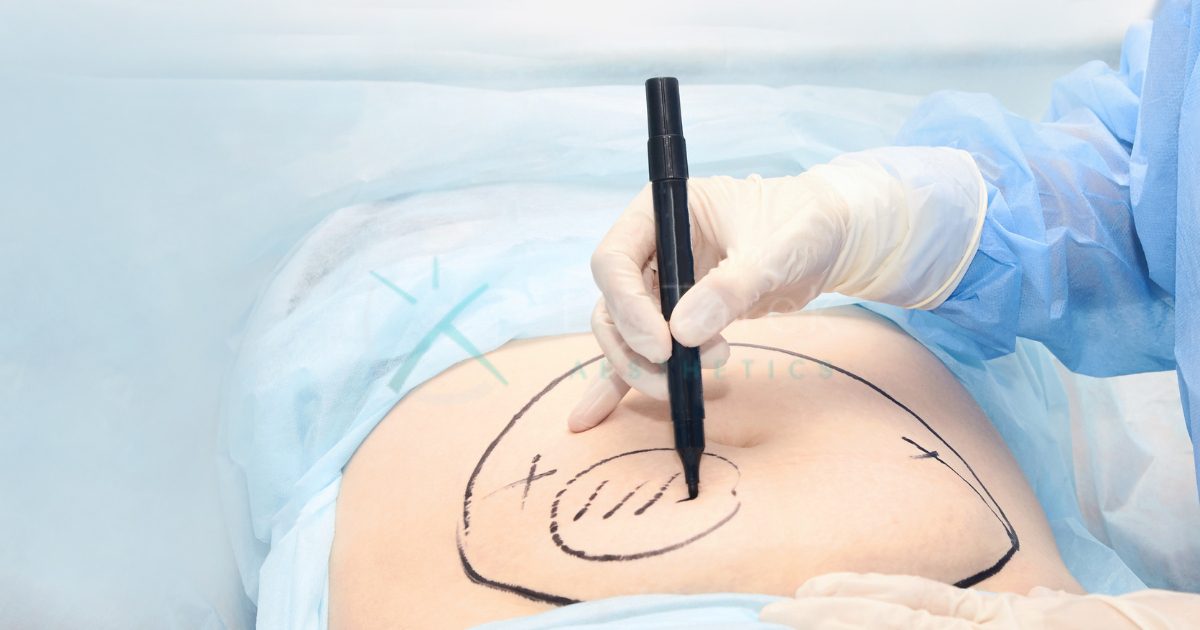 Airsculpt Liposuction: All You Need To Know