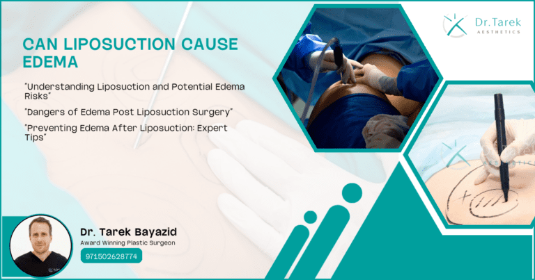 Can Liposuction Cause Edema