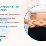 Can Liposuction Cause Varicose Veins