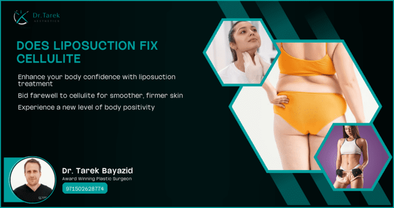 Does Liposuction Fix Cellulite