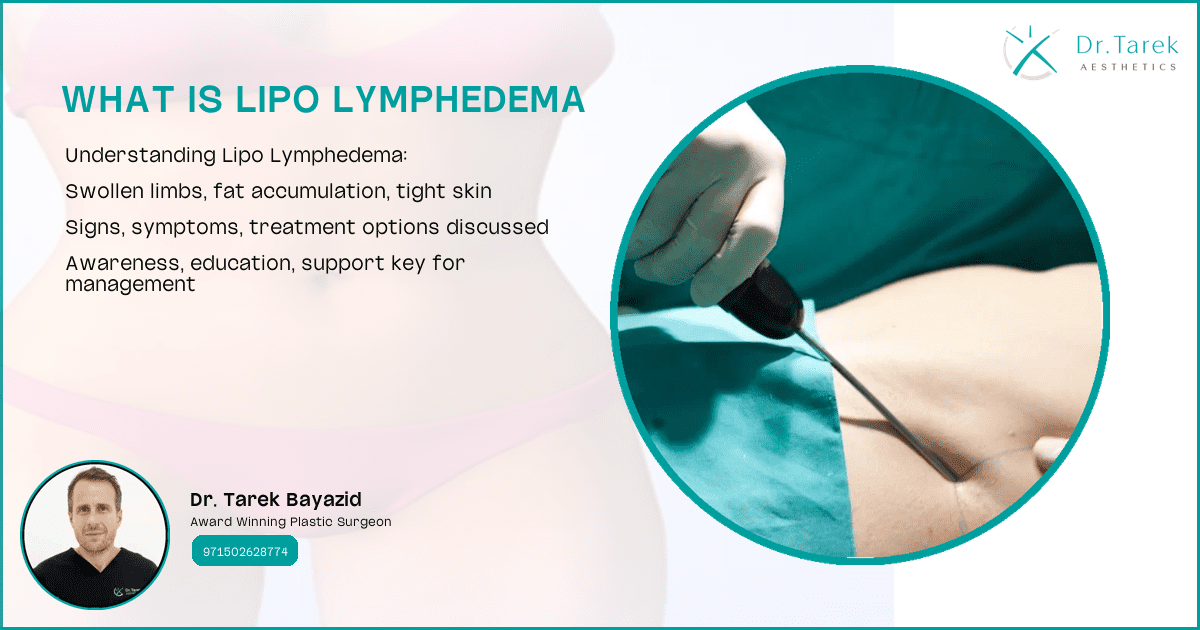 What Is Lipo Lymphedema