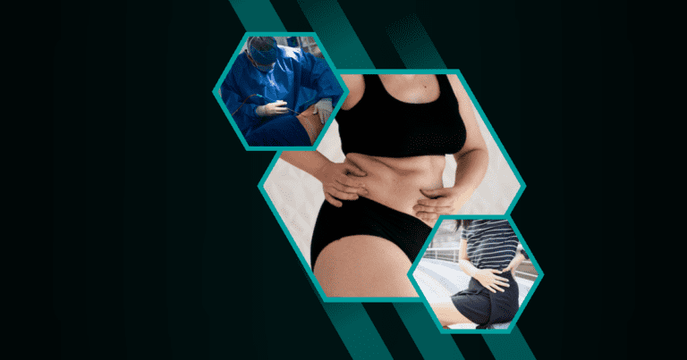 Can Liposuction Fix Hip Dips