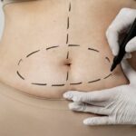 Waistline Liposuction