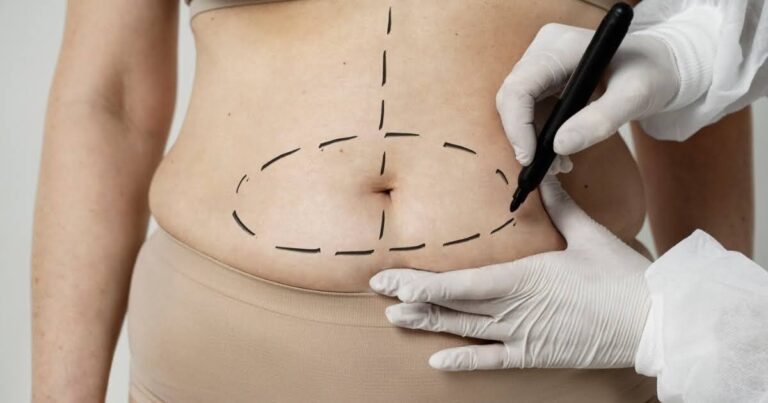 Waistline Liposuction