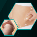 Can Liposuction Get Rid Of Visceral Fat